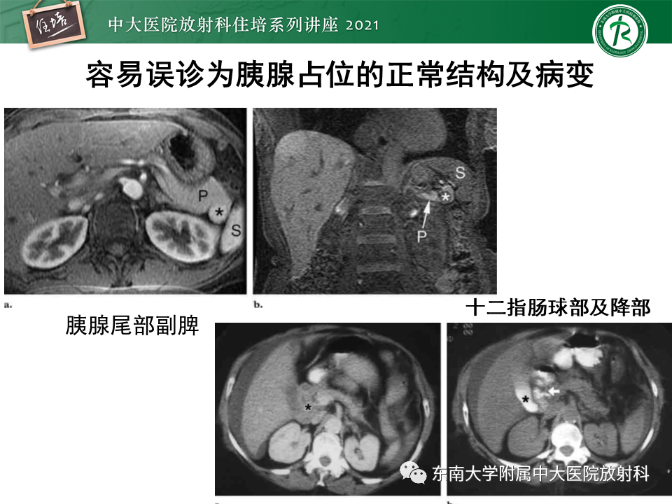 影像PPT - 【PPT】胰腺导管腺癌的影像诊断、评估及鉴别诊断-44