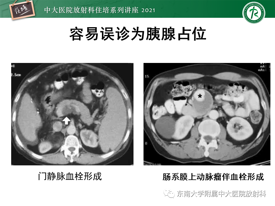 影像PPT - 【PPT】胰腺导管腺癌的影像诊断、评估及鉴别诊断-45
