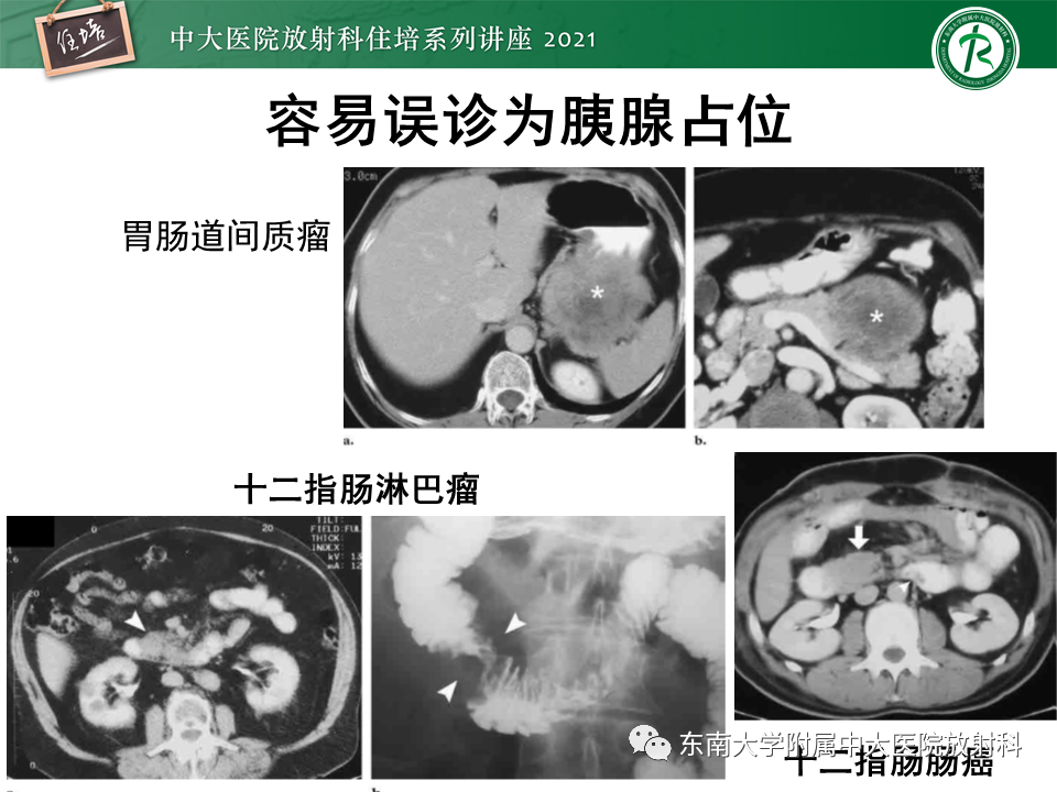 影像PPT - 【PPT】胰腺导管腺癌的影像诊断、评估及鉴别诊断-46