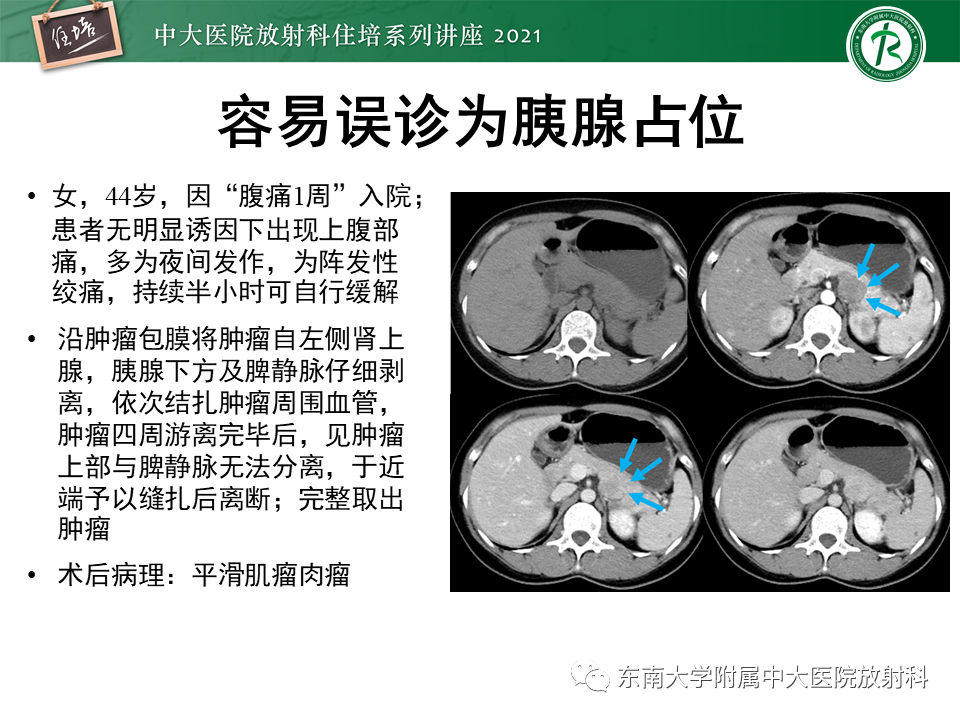 影像PPT - 【PPT】胰腺导管腺癌的影像诊断、评估及鉴别诊断-47