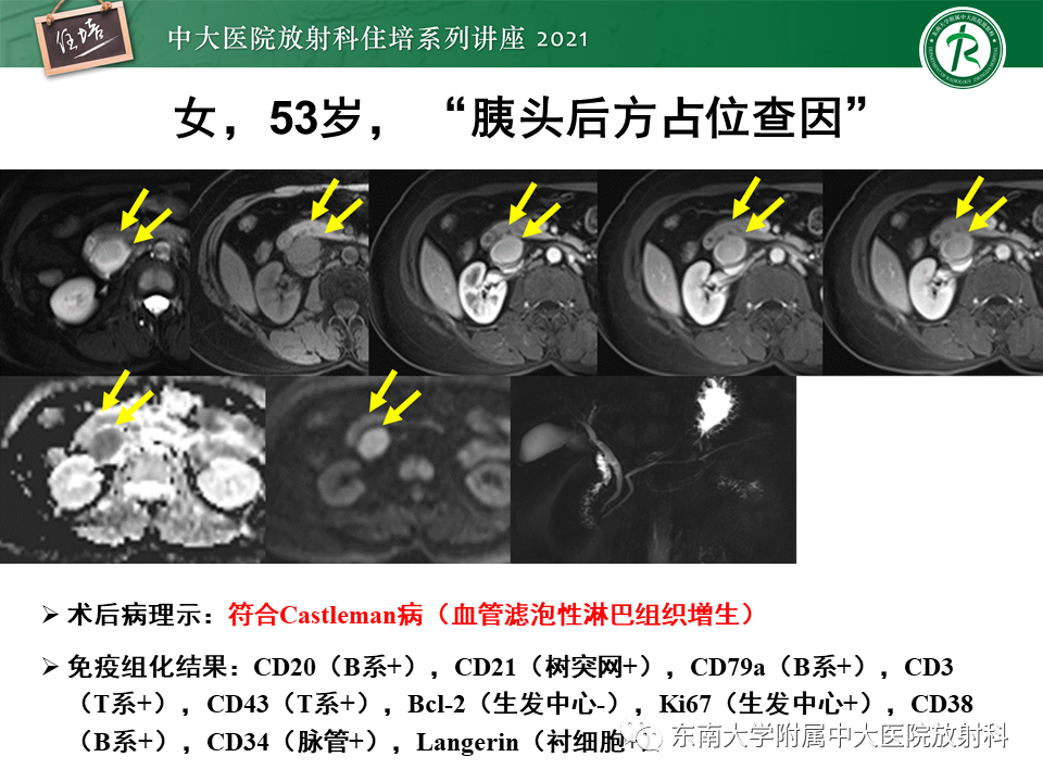 影像PPT - 【PPT】胰腺导管腺癌的影像诊断、评估及鉴别诊断-48