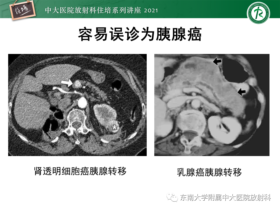 影像PPT - 【PPT】胰腺导管腺癌的影像诊断、评估及鉴别诊断-49