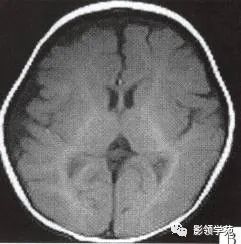 影像PPT - 【病例】脑颜面血管瘤综合征(Sturge-Weber综合征)1例MR-2 影像PPT - 【病例】脑颜面血管瘤综合征(Sturge-Weber综合征)1例MR-2