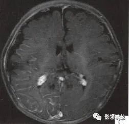 影像PPT - 【病例】脑颜面血管瘤综合征(Sturge-Weber综合征)1例MR-3 影像PPT - 【病例】脑颜面血管瘤综合征(Sturge-Weber综合征)1例MR-3