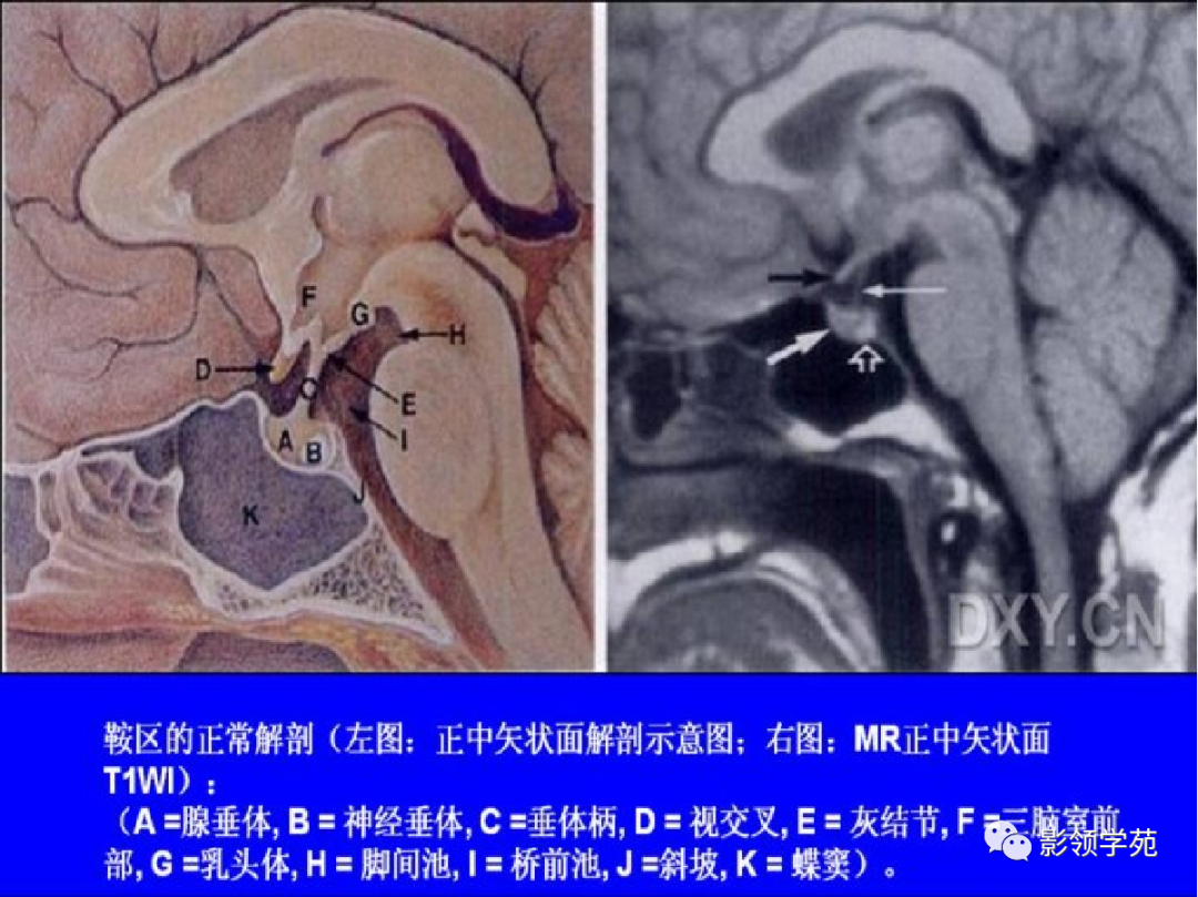 影像PPT - 鞍区常见肿瘤的影像鉴别诊断-1 影像PPT - 鞍区常见肿瘤的影像鉴别诊断-1