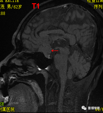 影像PPT - 鞍区常见肿瘤的影像鉴别诊断-26 影像PPT - 鞍区常见肿瘤的影像鉴别诊断-26