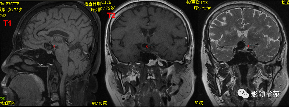影像PPT - 鞍区常见肿瘤的影像鉴别诊断-39 影像PPT - 鞍区常见肿瘤的影像鉴别诊断-39