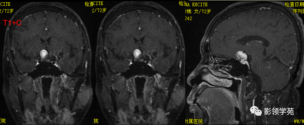 影像PPT - 鞍区常见肿瘤的影像鉴别诊断-40 影像PPT - 鞍区常见肿瘤的影像鉴别诊断-40