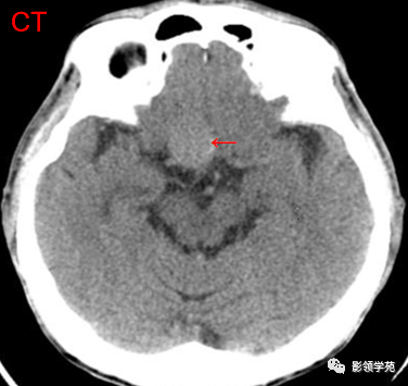影像PPT - 鞍区常见肿瘤的影像鉴别诊断-42 影像PPT - 鞍区常见肿瘤的影像鉴别诊断-42