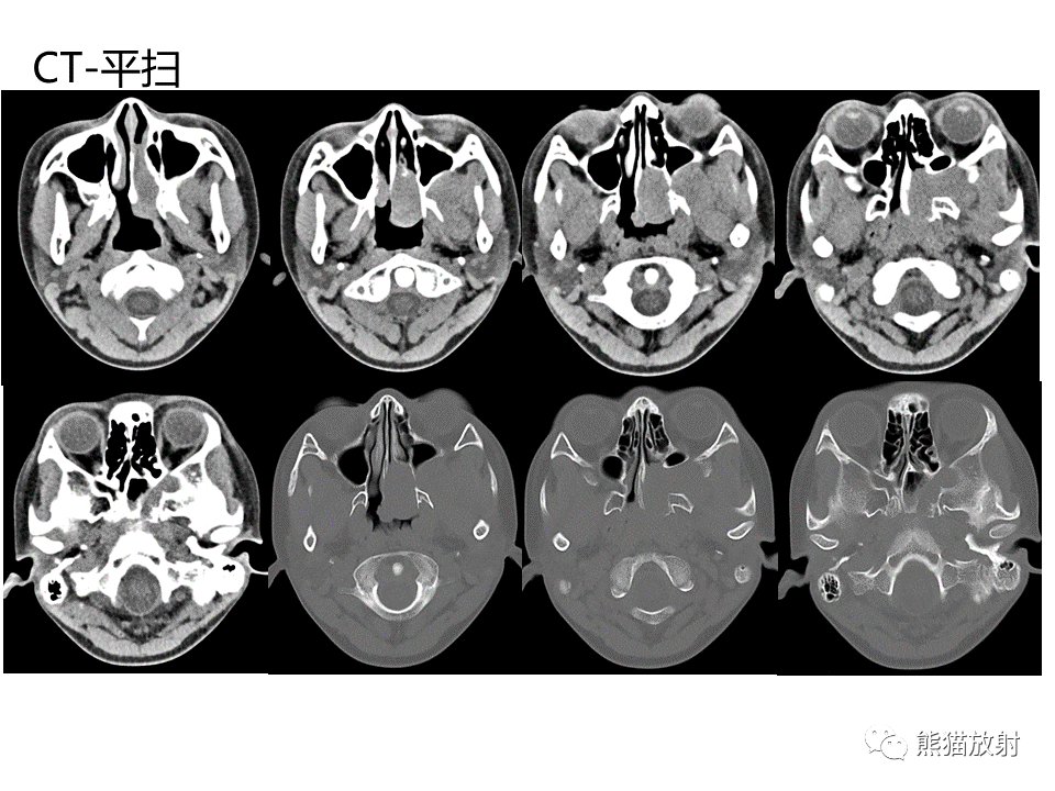 影像PPT - 【病例】鼻咽纤维血管瘤VS鼻咽癌CT及MR影像-3