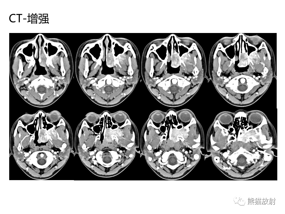 影像PPT - 【病例】鼻咽纤维血管瘤VS鼻咽癌CT及MR影像-4