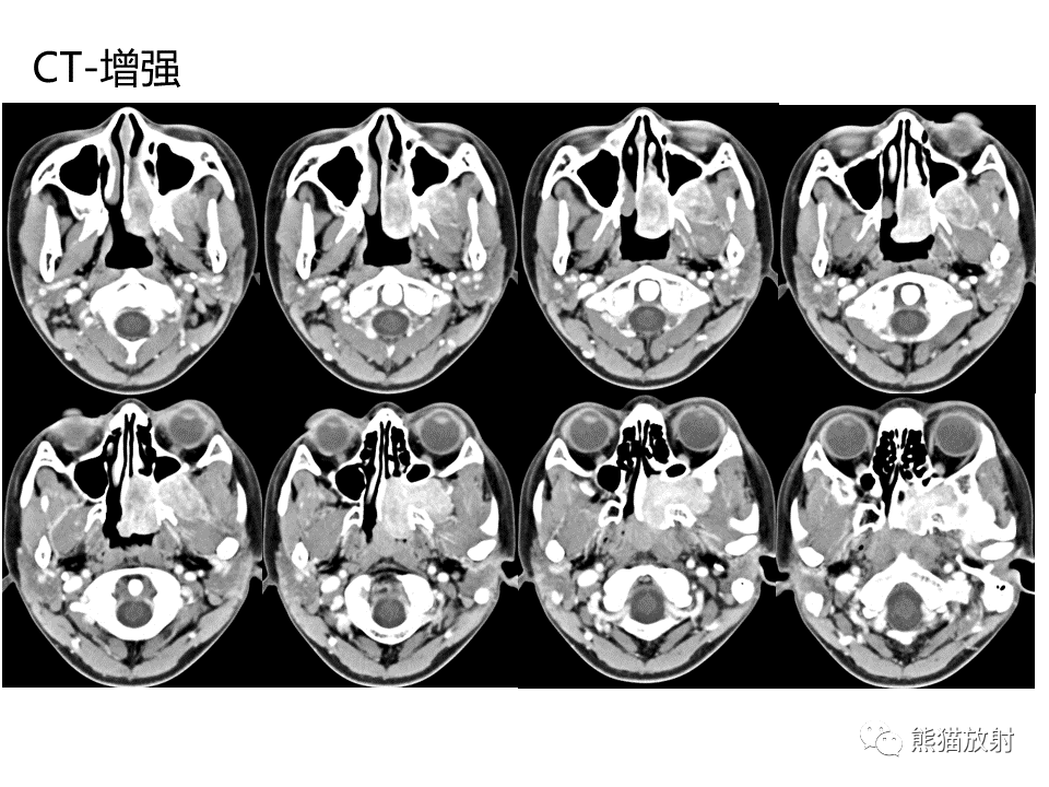 影像PPT - 【病例】鼻咽纤维血管瘤VS鼻咽癌CT及MR影像-5