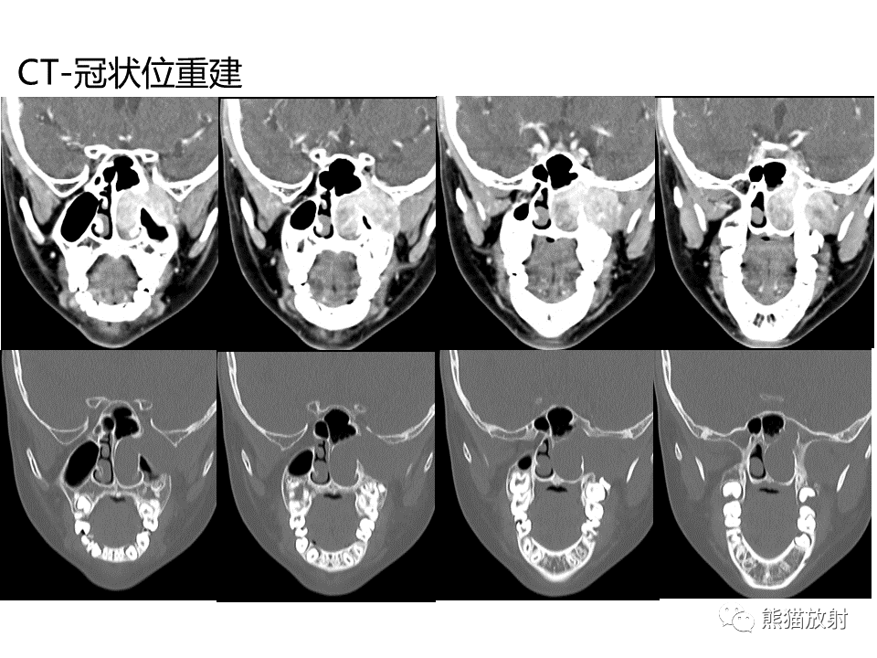 影像PPT - 【病例】鼻咽纤维血管瘤VS鼻咽癌CT及MR影像-6