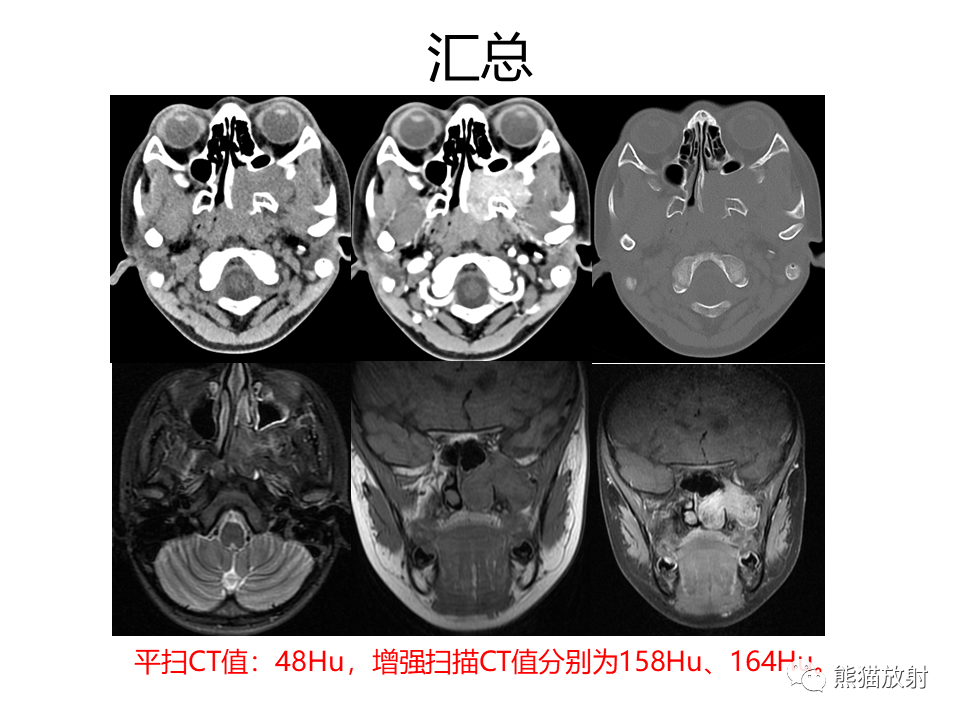 影像PPT - 【病例】鼻咽纤维血管瘤VS鼻咽癌CT及MR影像-11