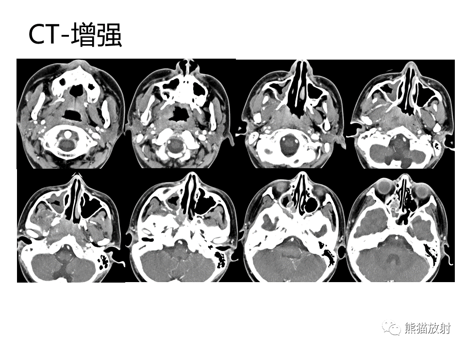 影像PPT - 【病例】鼻咽纤维血管瘤VS鼻咽癌CT及MR影像-16