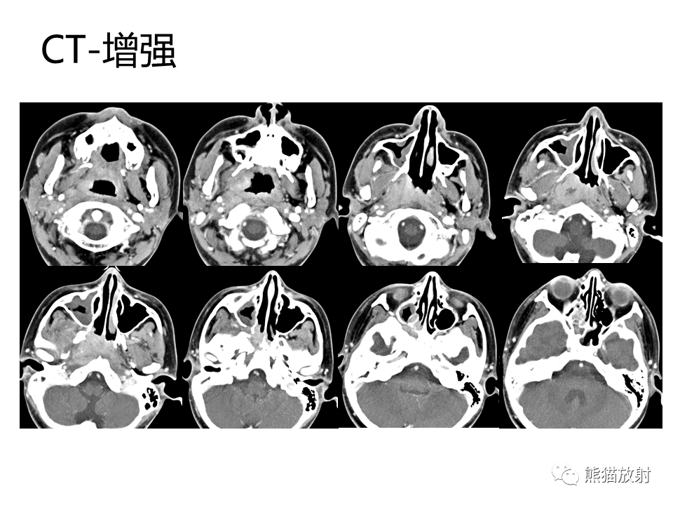 影像PPT - 【病例】鼻咽纤维血管瘤VS鼻咽癌CT及MR影像-17