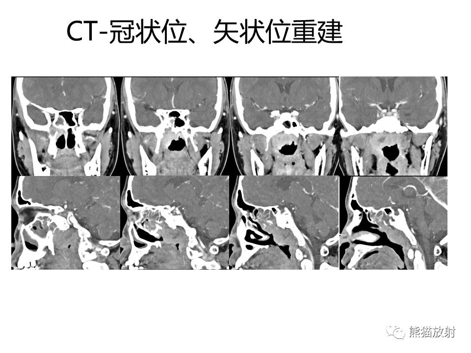 影像PPT - 【病例】鼻咽纤维血管瘤VS鼻咽癌CT及MR影像-18