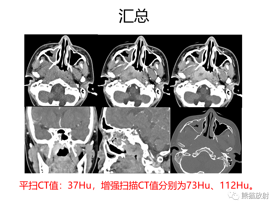 影像PPT - 【病例】鼻咽纤维血管瘤VS鼻咽癌CT及MR影像-19