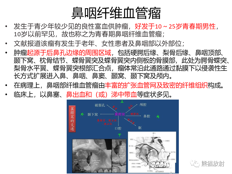 影像PPT - 【病例】鼻咽纤维血管瘤VS鼻咽癌CT及MR影像-22