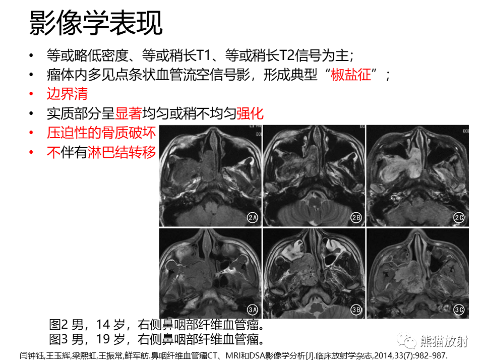 影像PPT - 【病例】鼻咽纤维血管瘤VS鼻咽癌CT及MR影像-23