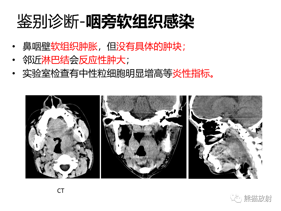 影像PPT - 【病例】鼻咽纤维血管瘤VS鼻咽癌CT及MR影像-26