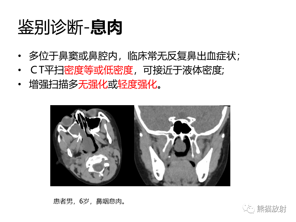 影像PPT - 【病例】鼻咽纤维血管瘤VS鼻咽癌CT及MR影像-27