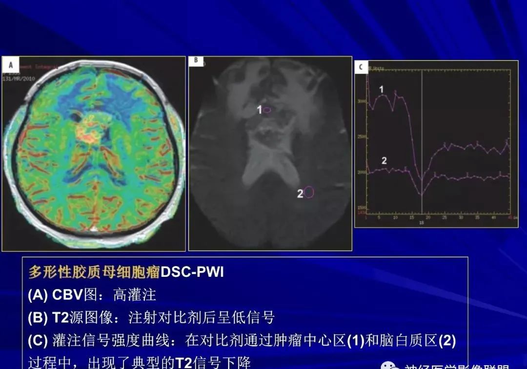 影像PPT - 【PPT】颅内短T2信号病变的影像学诊断及鉴别-6