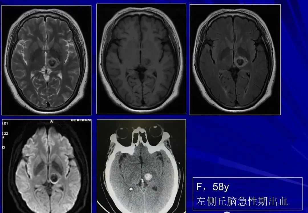 影像PPT - 【PPT】颅内短T2信号病变的影像学诊断及鉴别-10