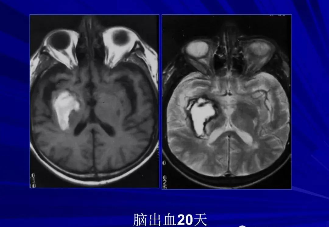 影像PPT - 【PPT】颅内短T2信号病变的影像学诊断及鉴别-12