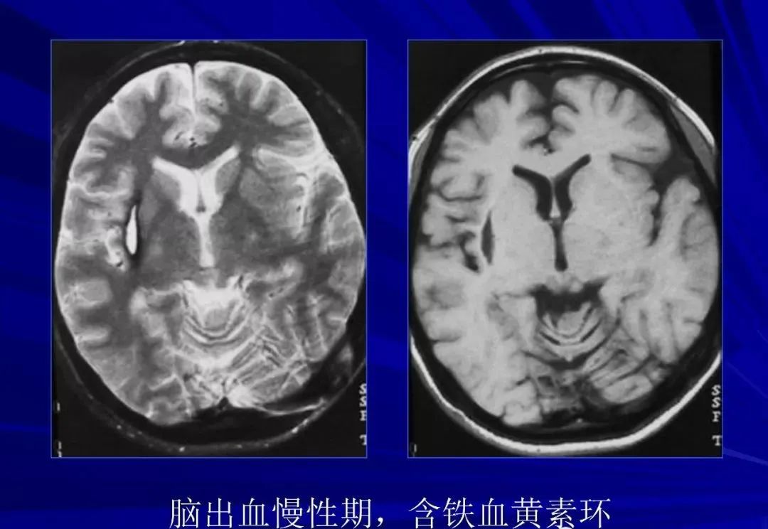 影像PPT - 【PPT】颅内短T2信号病变的影像学诊断及鉴别-13
