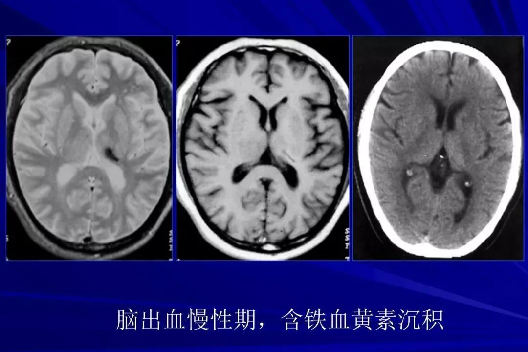 影像PPT - 【PPT】颅内短T2信号病变的影像学诊断及鉴别-14