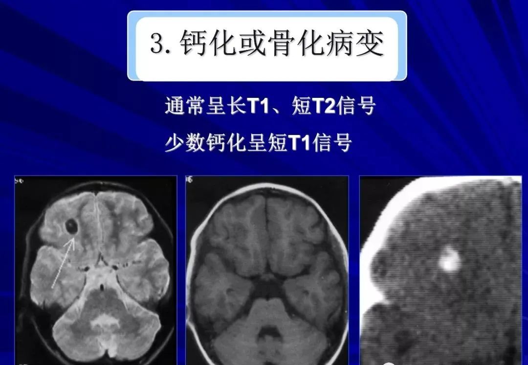 影像PPT - 【PPT】颅内短T2信号病变的影像学诊断及鉴别-15
