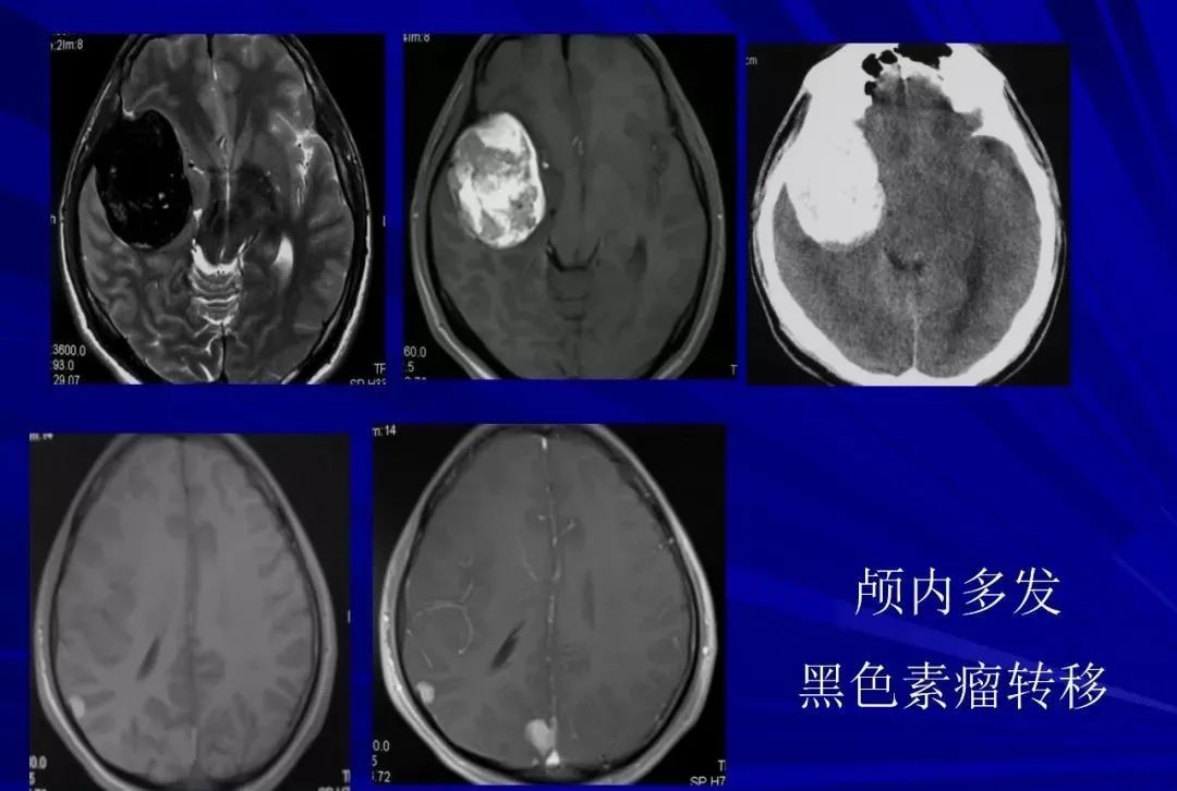 影像PPT - 【PPT】颅内短T2信号病变的影像学诊断及鉴别-19