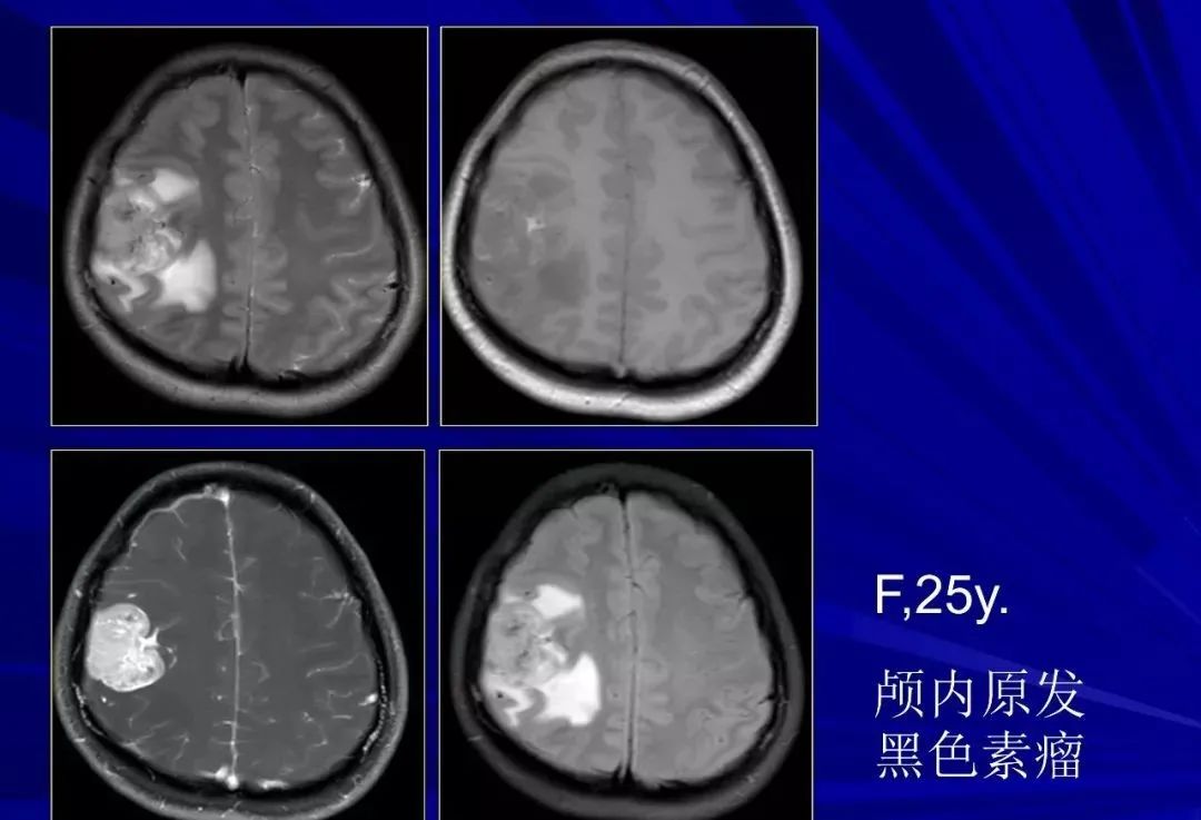 影像PPT - 【PPT】颅内短T2信号病变的影像学诊断及鉴别-20