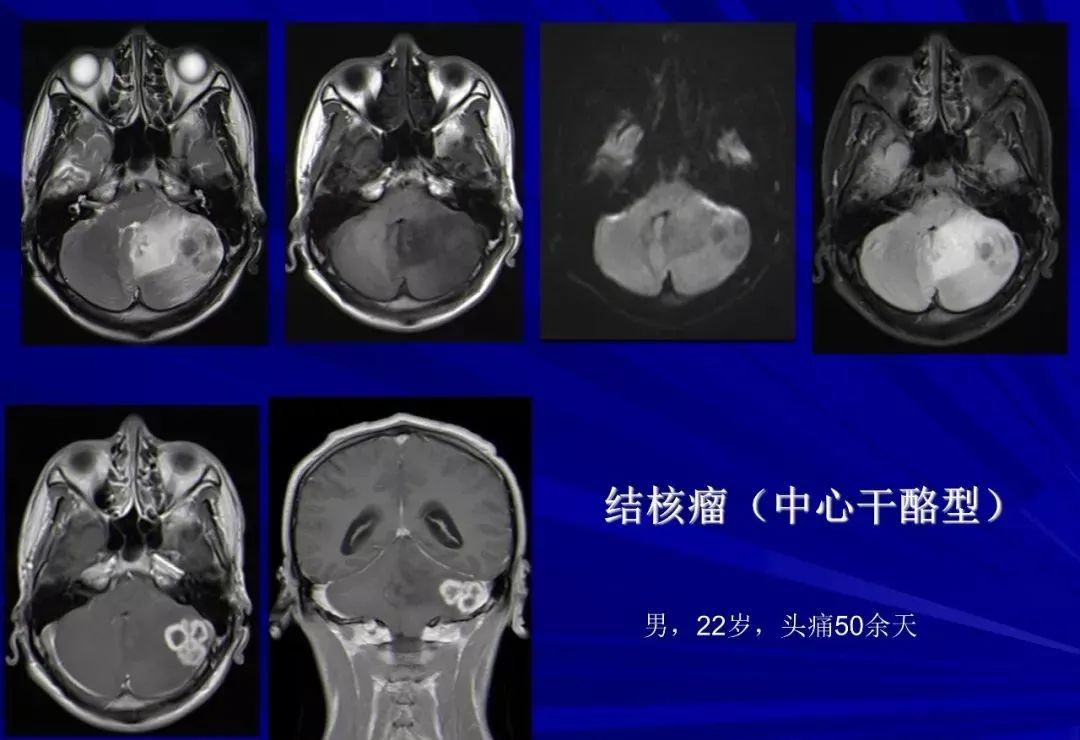 影像PPT - 【PPT】颅内短T2信号病变的影像学诊断及鉴别-36