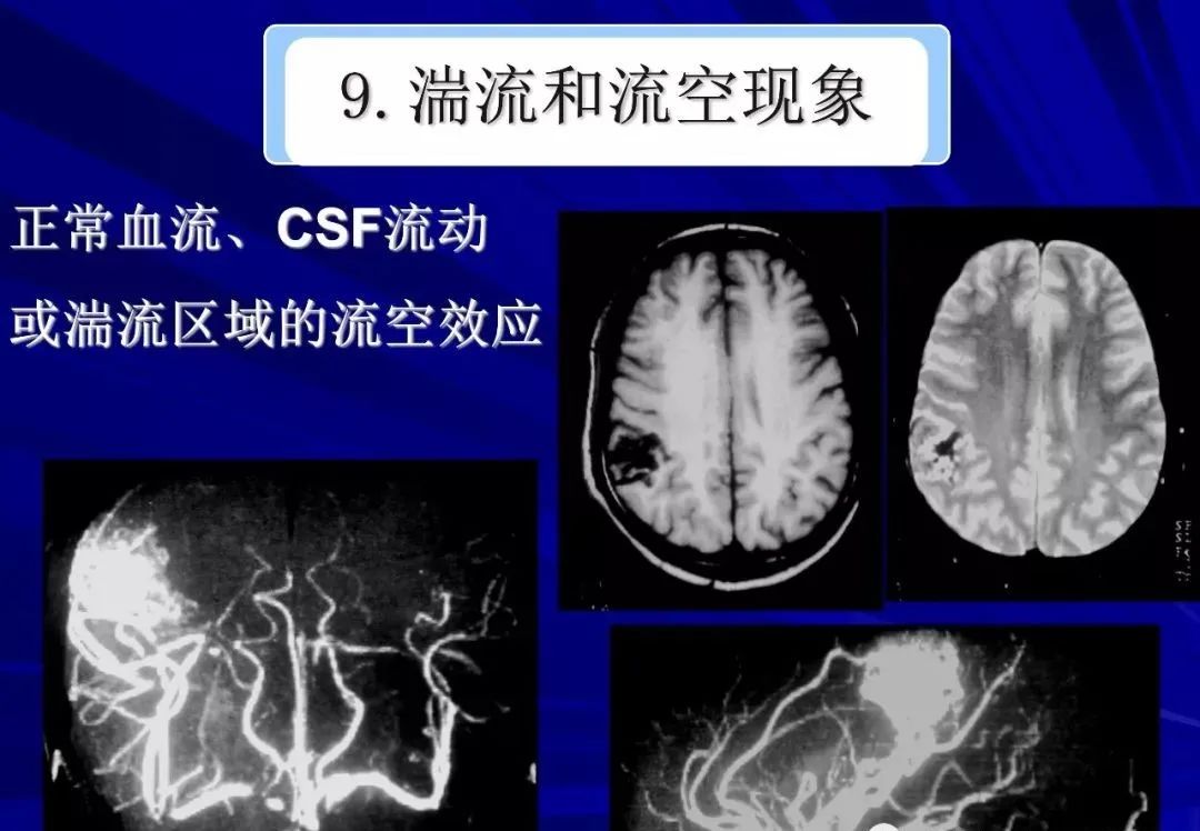 影像PPT - 【PPT】颅内短T2信号病变的影像学诊断及鉴别-38