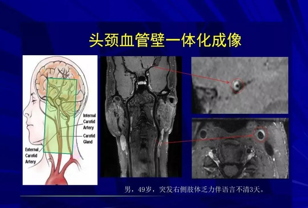 影像PPT - 【PPT】颅内短T2信号病变的影像学诊断及鉴别-40