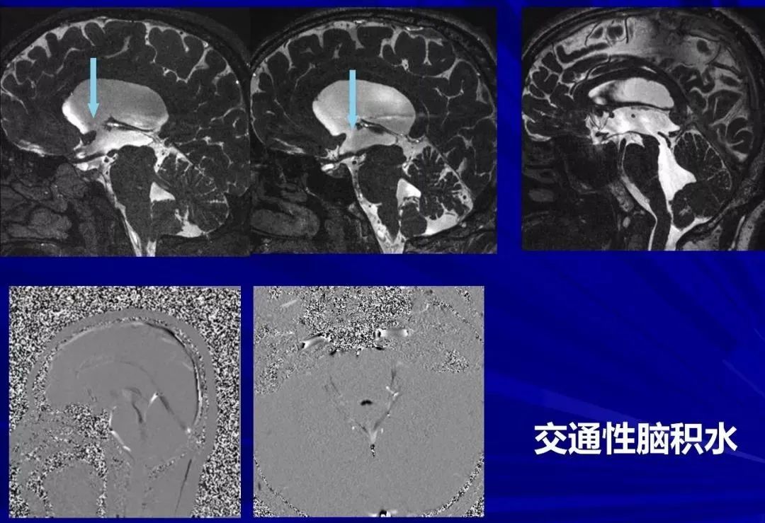 影像PPT - 【PPT】颅内短T2信号病变的影像学诊断及鉴别-43