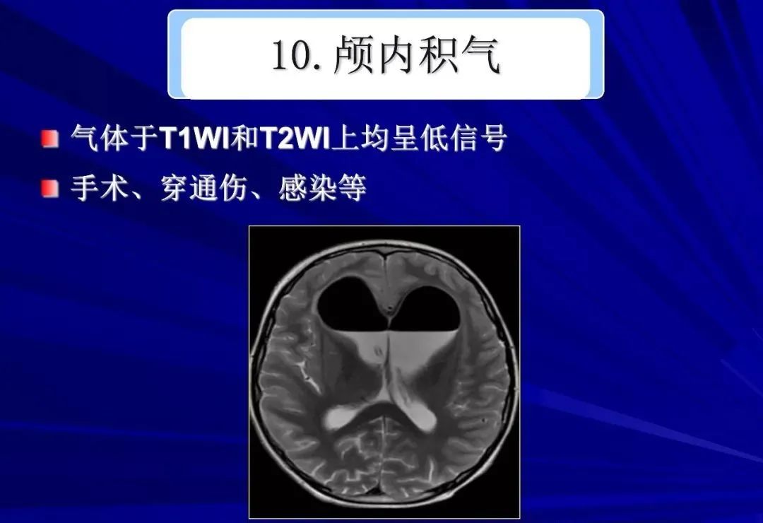 影像PPT - 【PPT】颅内短T2信号病变的影像学诊断及鉴别-44