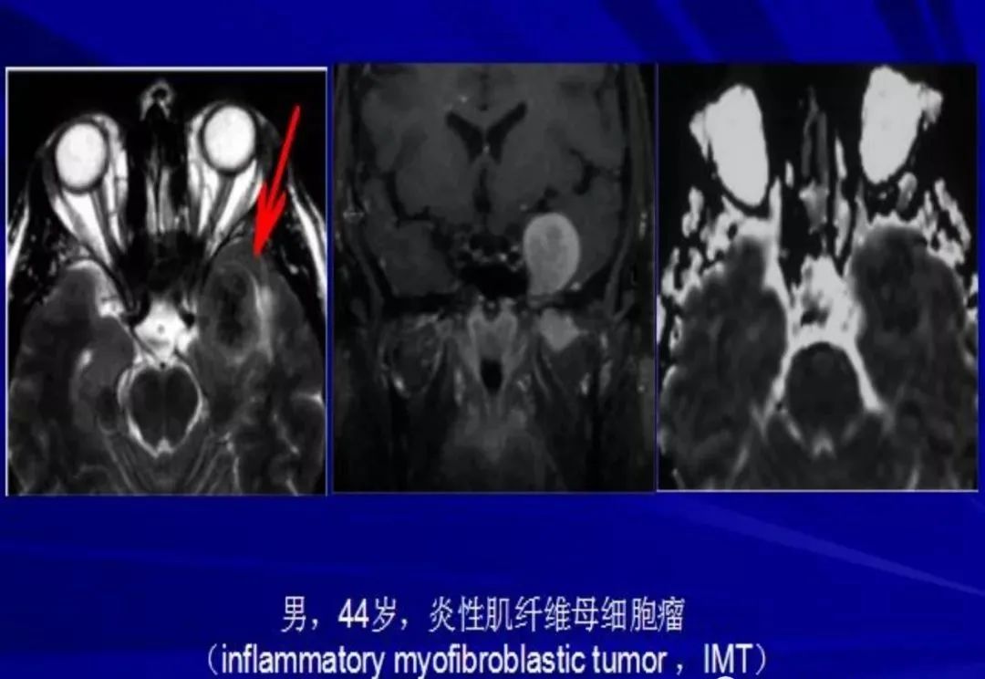 影像PPT - 【PPT】颅内短T2信号病变的影像学诊断及鉴别-47