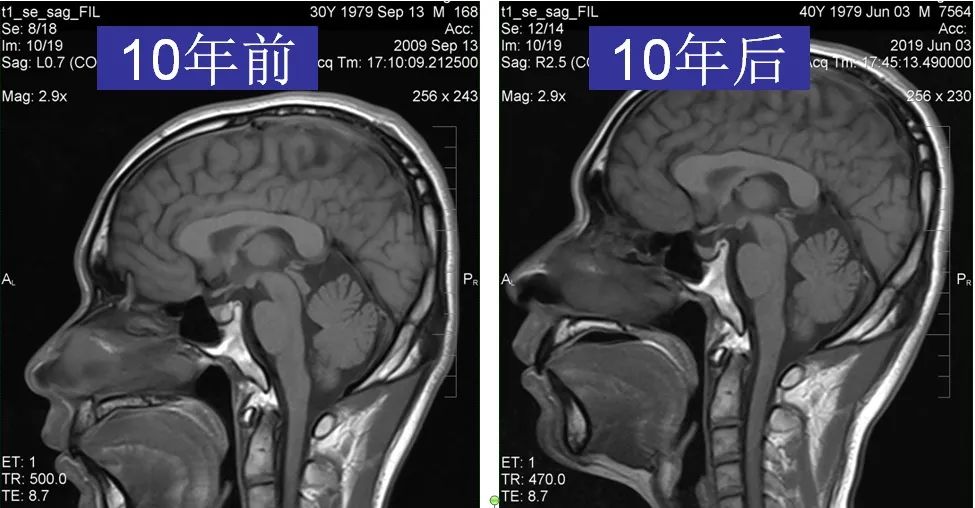影像PPT - 一起来认识这个表现多样的 Rathke’s囊肿-12