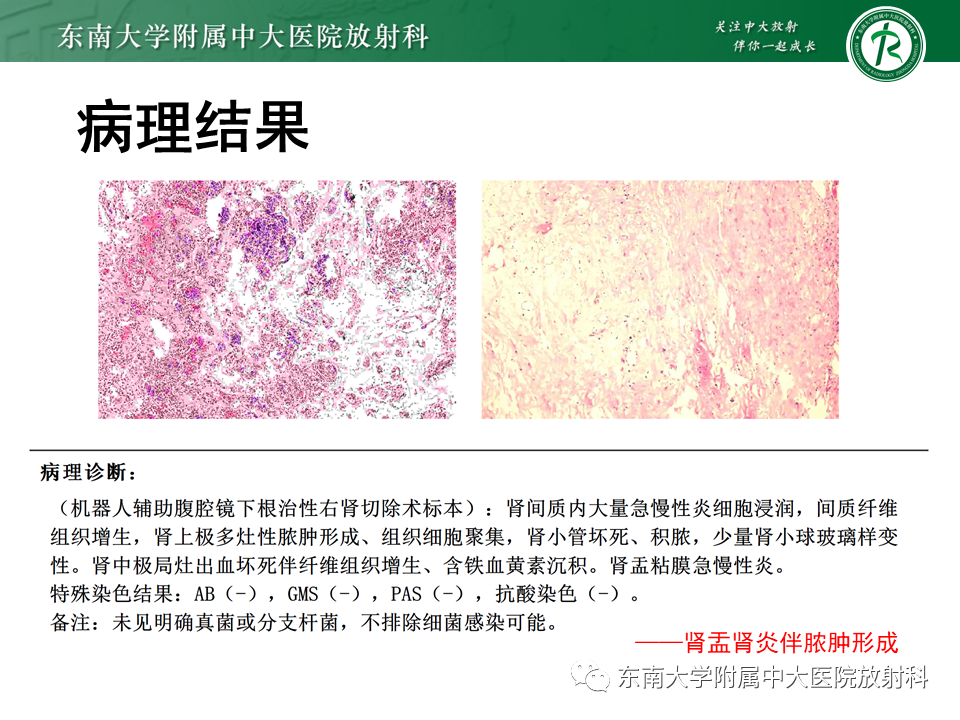 影像PPT - 【病例】肾盂肾炎1例CT及MR影像-4 影像PPT - 【病例】肾盂肾炎1例CT及MR影像-4