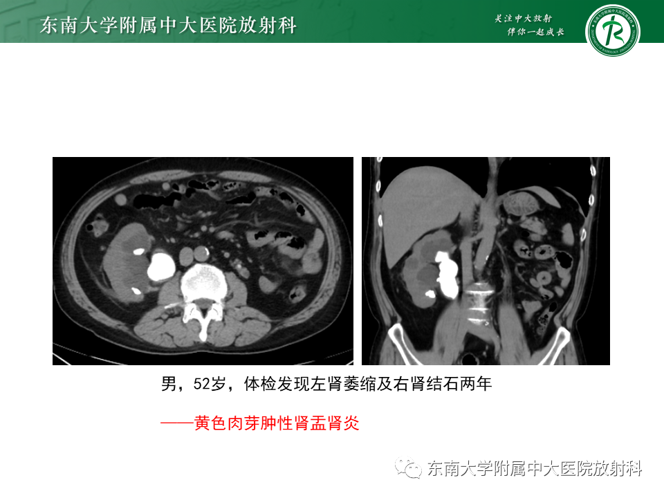 影像PPT - 【病例】肾盂肾炎1例CT及MR影像-14 影像PPT - 【病例】肾盂肾炎1例CT及MR影像-14