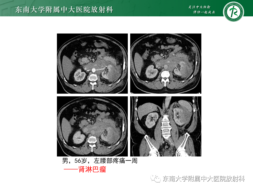 影像PPT - 【病例】肾盂肾炎1例CT及MR影像-23 影像PPT - 【病例】肾盂肾炎1例CT及MR影像-23