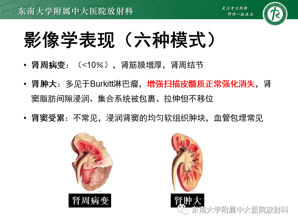 影像PPT - 【病例】肾盂肾炎1例CT及MR影像-26 影像PPT - 【病例】肾盂肾炎1例CT及MR影像-26
