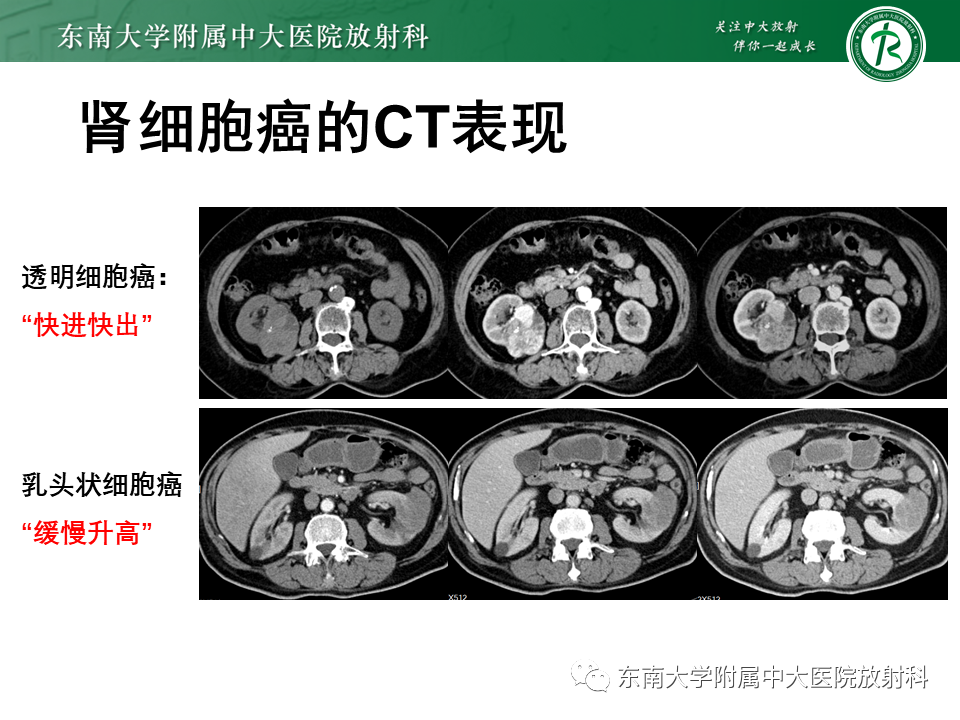 影像PPT - 【病例】肾盂肾炎1例CT及MR影像-33 影像PPT - 【病例】肾盂肾炎1例CT及MR影像-33