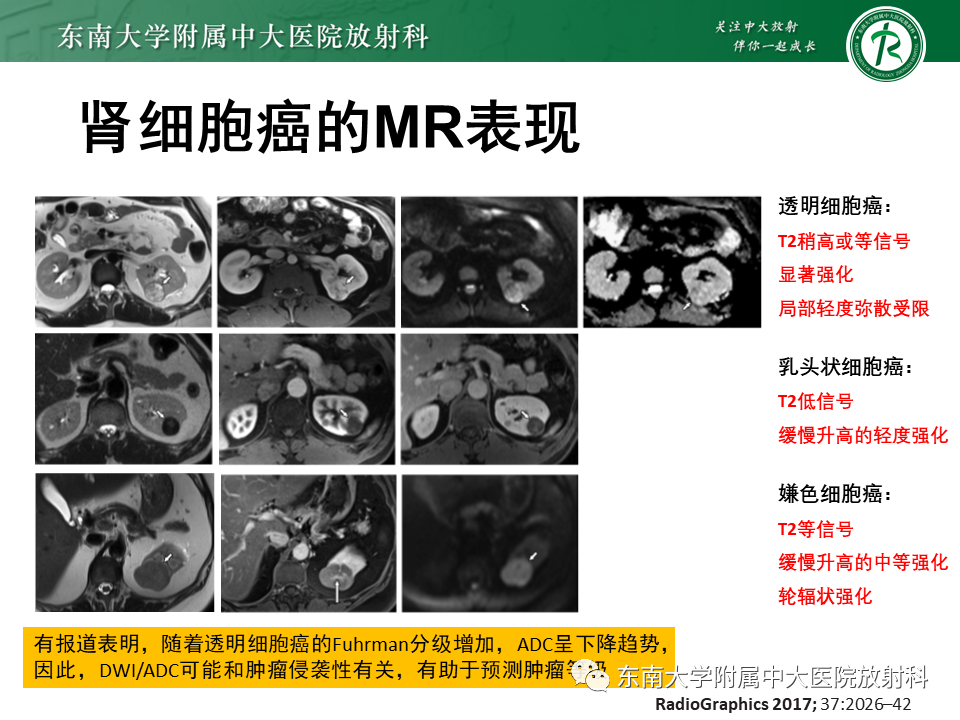 影像PPT - 【病例】肾盂肾炎1例CT及MR影像-34 影像PPT - 【病例】肾盂肾炎1例CT及MR影像-34