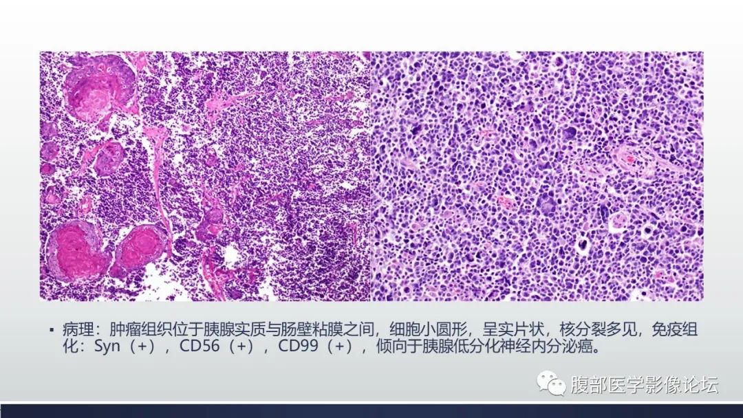 影像PPT - 【病例】胰腺神经内分泌癌1例CT影像-7