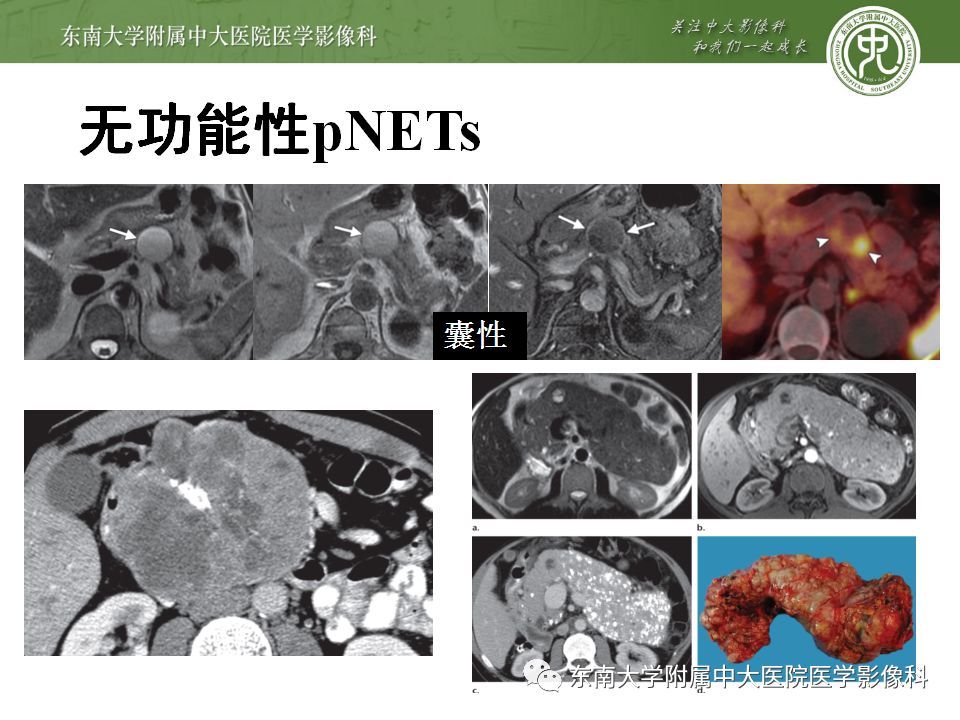 影像PPT - 【病例】胰腺神经内分泌癌1例CT影像-15
