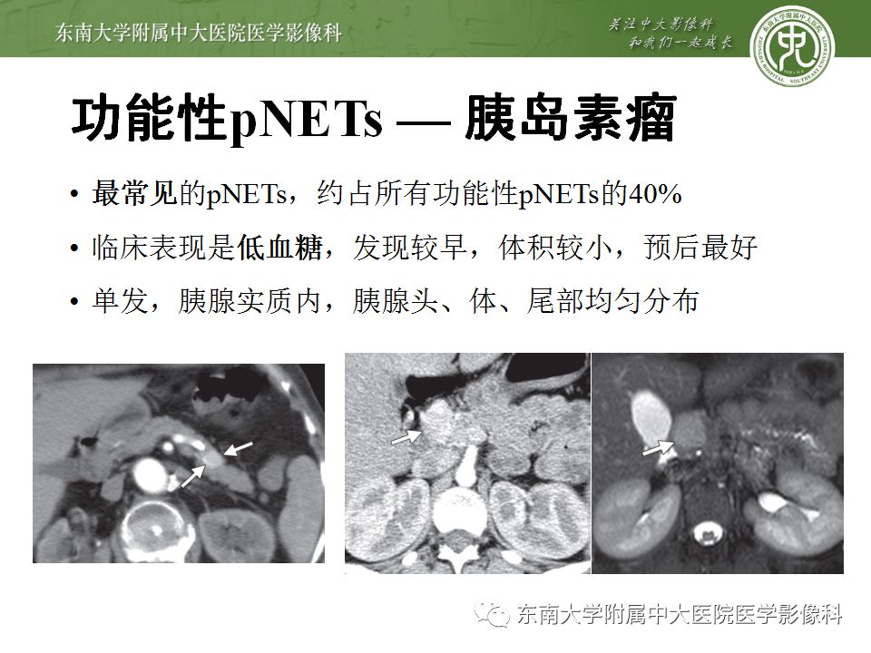 影像PPT - 【病例】胰腺神经内分泌癌1例CT影像-16
